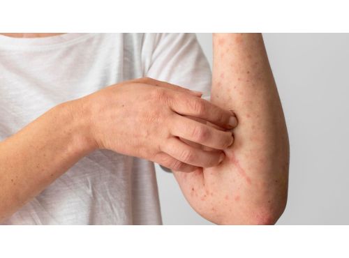 التهاب الجلد العصبي: الأسباب والأعراض وكيفية العلاج