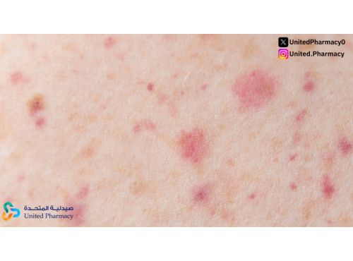  أسباب ظهور نقط حمراء في الجسم وكيفية التعامل الصحيح معها