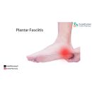 مرهم لعلاج التهاب اللفافة الأخمصية