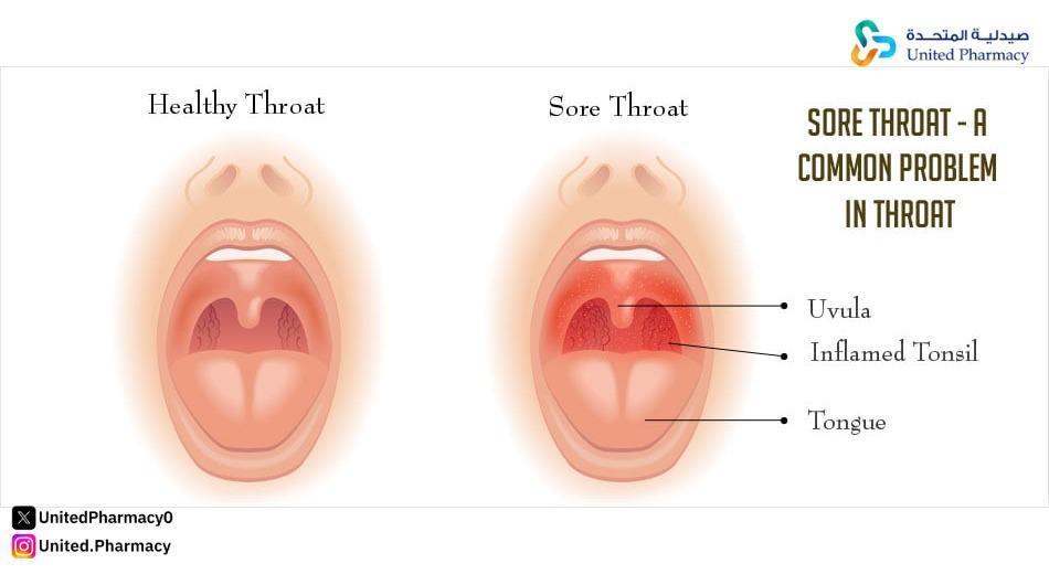 هي مضاعفات التهاب الحلق عند الكبار