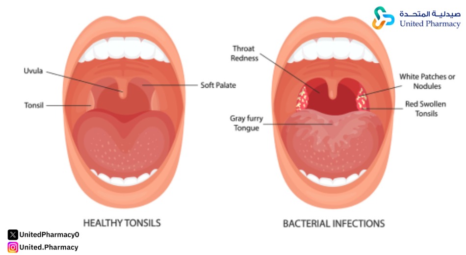 التهاب الحلق