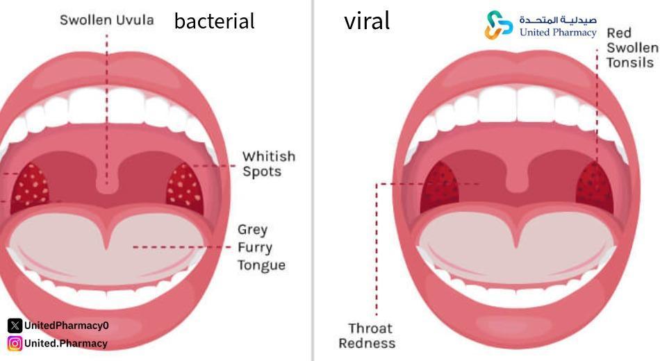 كيف أفرق بين التهاب الحلق البكتيري والتهاب الحلق الفيروسي