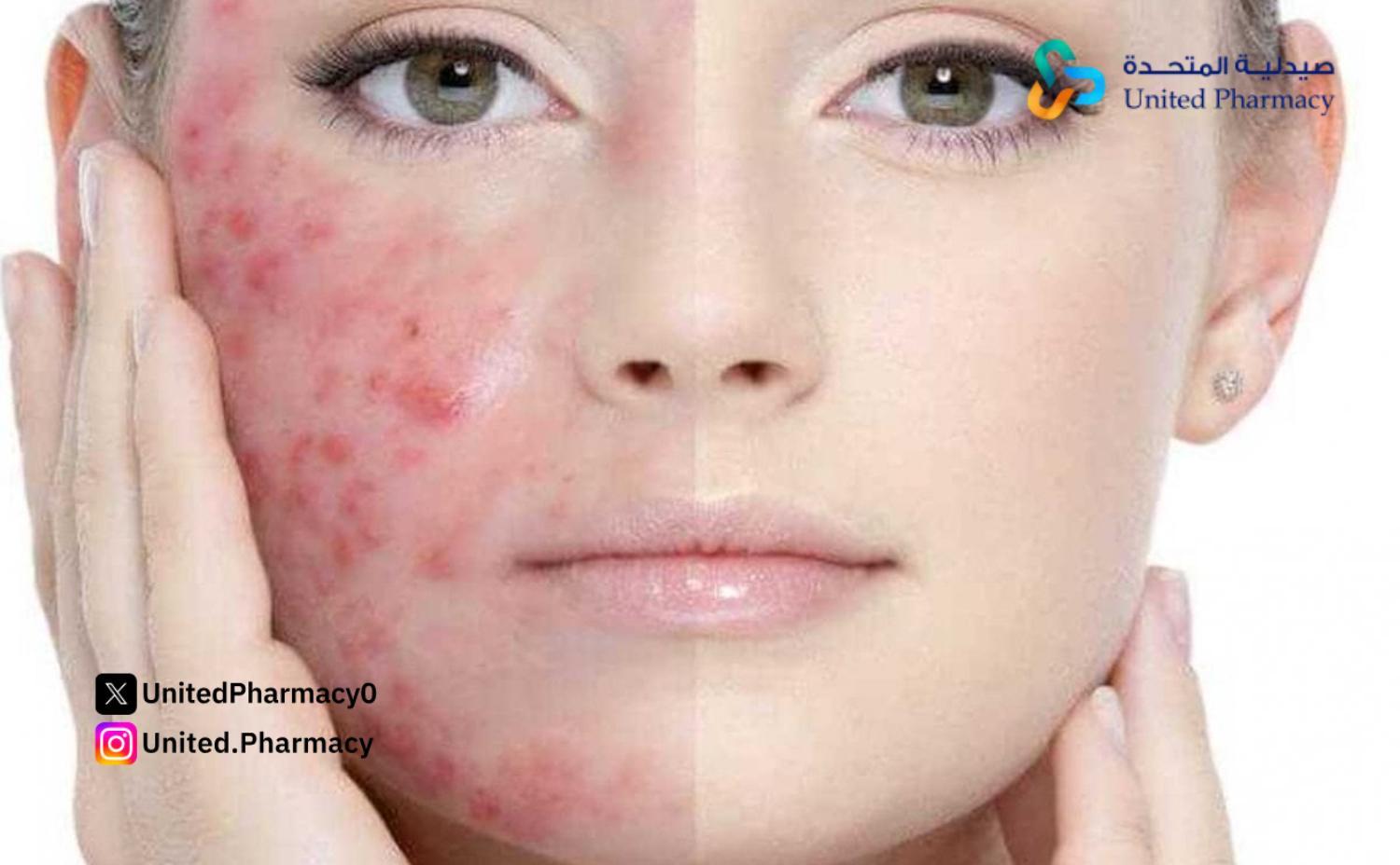 فوائد كريم فيوسيدين للوجه