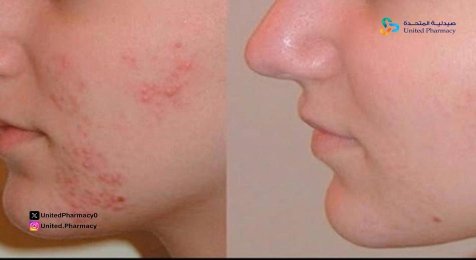 هل جل ديفرين يزيل اثار حب الشباب؟