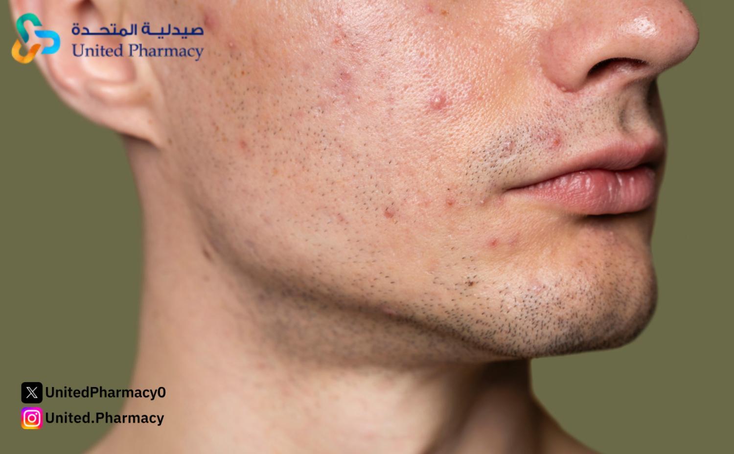 فيوسيدين لحب الشباب