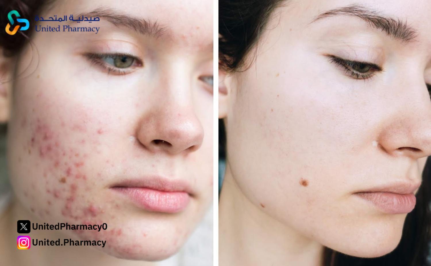 إزالة حبوب الشباب إزالة حبوب الشباب